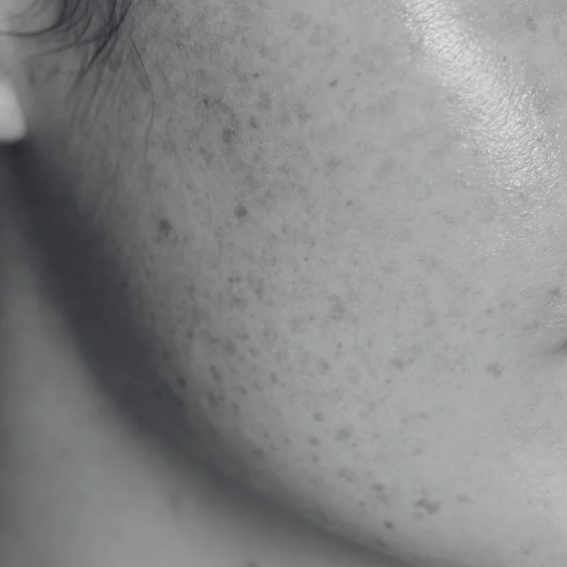 Women-oily-skin-bw Women-oily-skin-bw